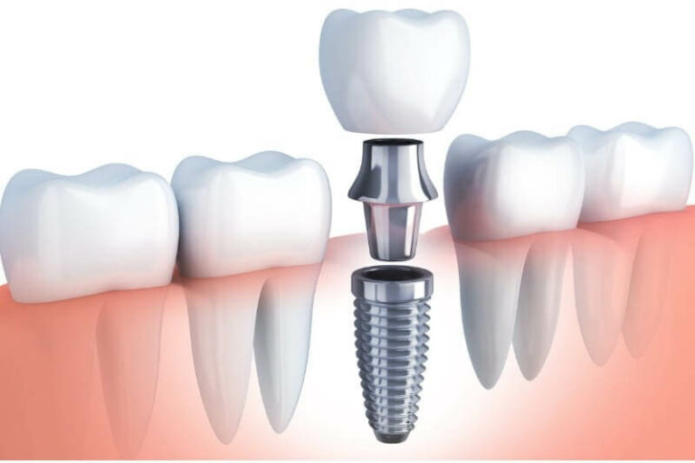 Are Dental Implants Noticeable?